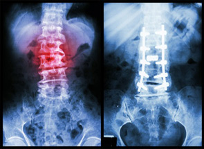 Medtronic Infuse Xray